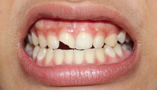 歯が欠けた…すぐに歯医者に行けないときの正しい応急処置と放置のリスクとは？